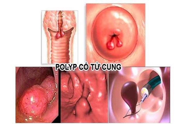 Tìm hiểu về nang naboth cổ tử cung