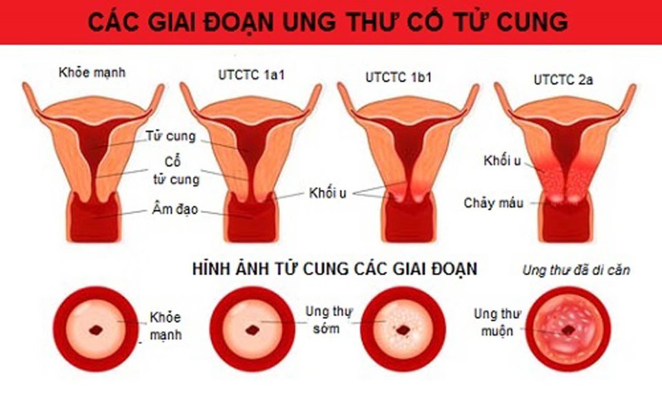 Phương pháp điều trị bệnh ung thư cổ tử cung