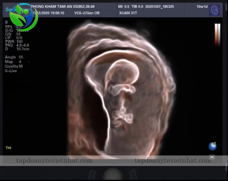 Công nghệ siêu âm S-Live Silhouette siêu âm thai nhi