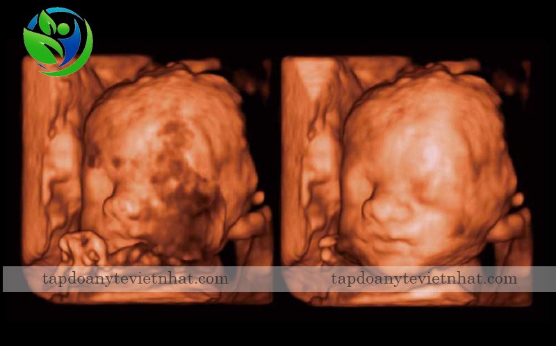 Auto face cho hình ảnh thai nhi sắc nét