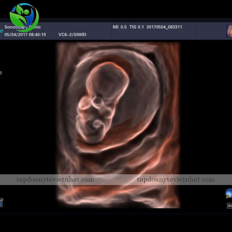 S-Live Silhouette trong siêu âm thai nhi