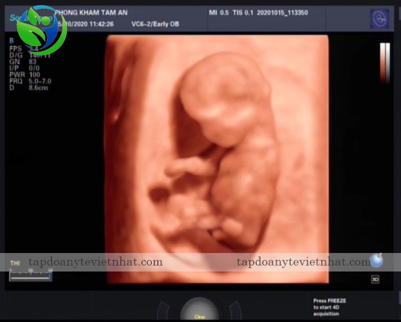 Hình ảnh thai nhi rất chi tiết trên SonoScape P50