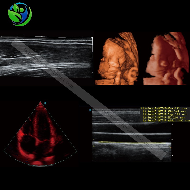 Máy siêu âm thai nhi 5D của Mỹ thương hiệu SonoScape