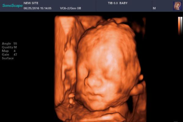 Công nghệ tự động nhận diện khuôn mặt thai nhi