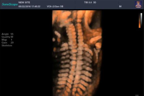 S-Skeleton giúp siêu âm xương thai nhi trên S60