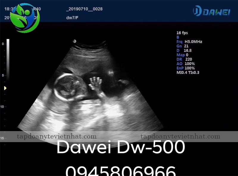 Ảnh siêu âm thai trên Dawei DW-500
