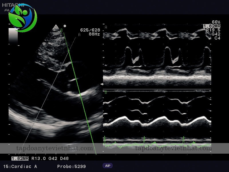 Hình ảnh chân thực khi siêu âm tim trên máy Hitachi Aloka F31