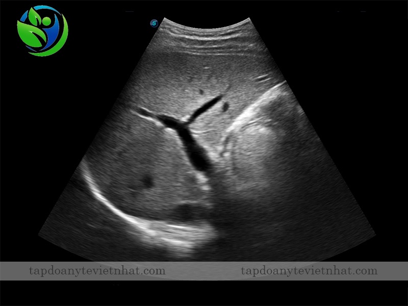 Hình ảnh kết quả siêu âm trên SonoScape E1