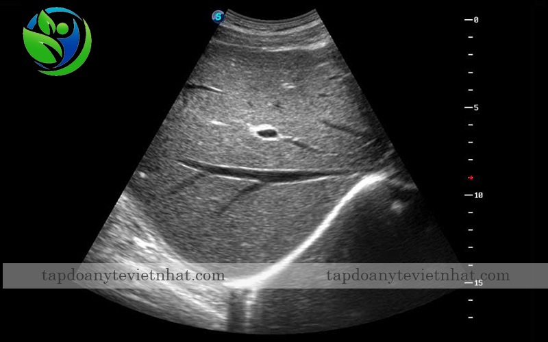 Siêu âm gan trên P9 với u-scan