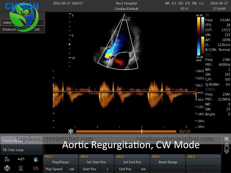 siêu âm hồi lưu động mạch chủ chế độ cw