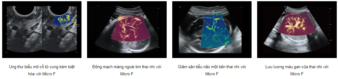 Máy siêu âm 5D SonoScape P80 Elite