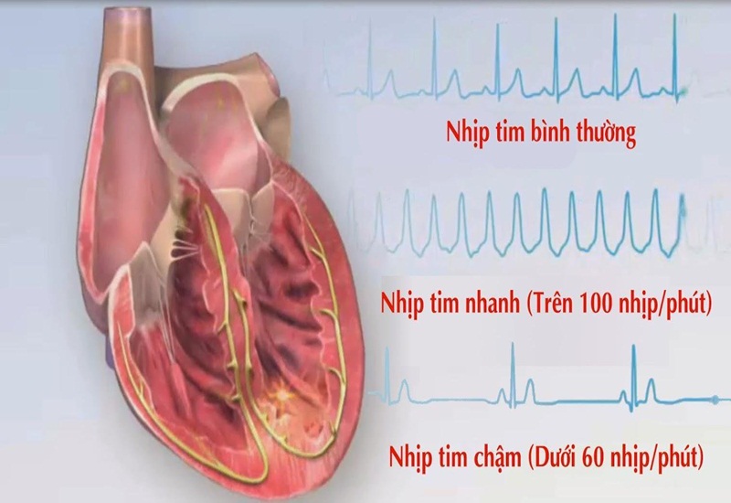 Chẩn đoán loạn tim nhịp xoang