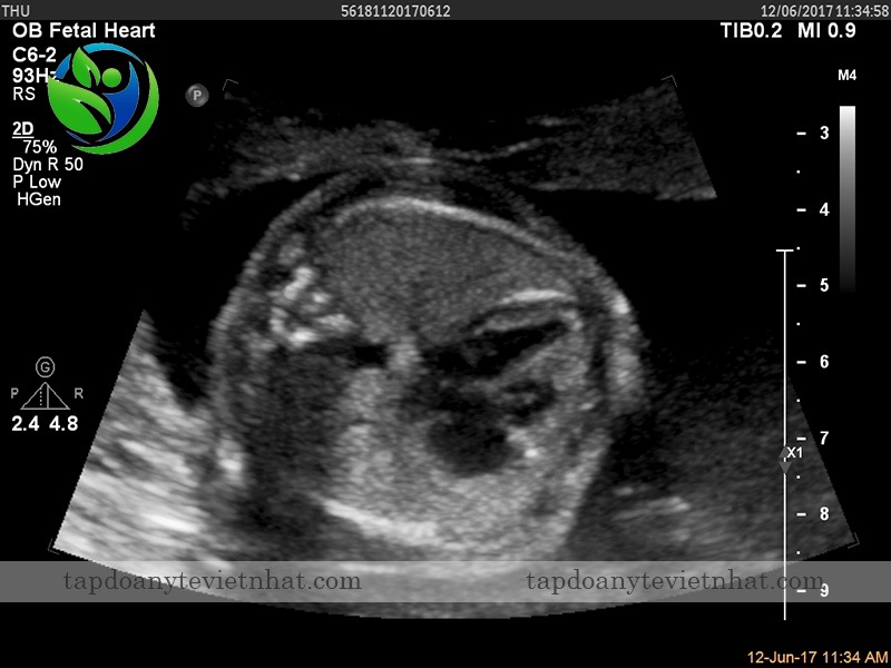  Hình ảnh thai trong tử cung khi 4 tuần tuổi