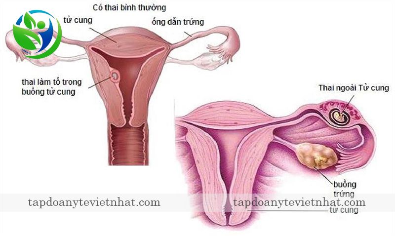 hình ảnh thai ngoài tử cung