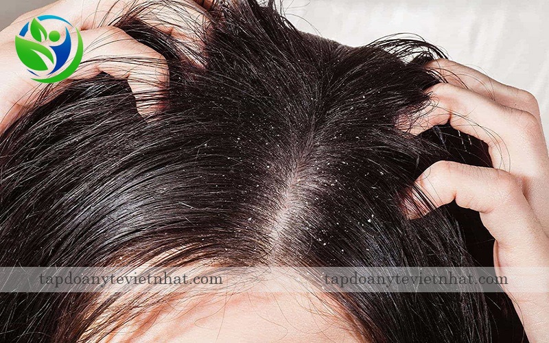 Nấm đầu là nguyên nhân dẫn tới chân tóc bị tổn thương và gây rụng tóc