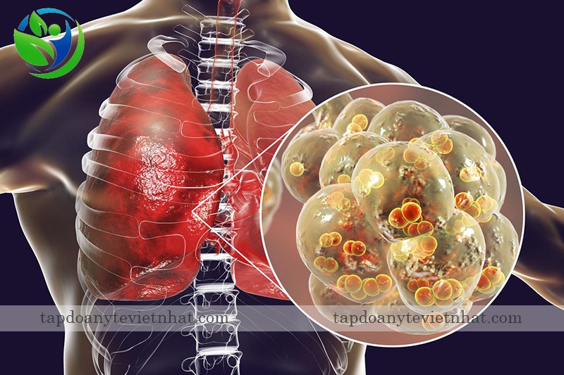 biến chứng viêm phổi của bệnh viêm amidan