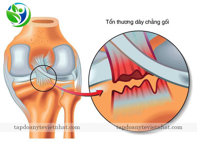  Siêu âm khớp gối có thể phát hiện bệnh gân xương bánh chè  