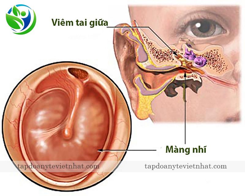 hình ảnh viêm tai giữa
