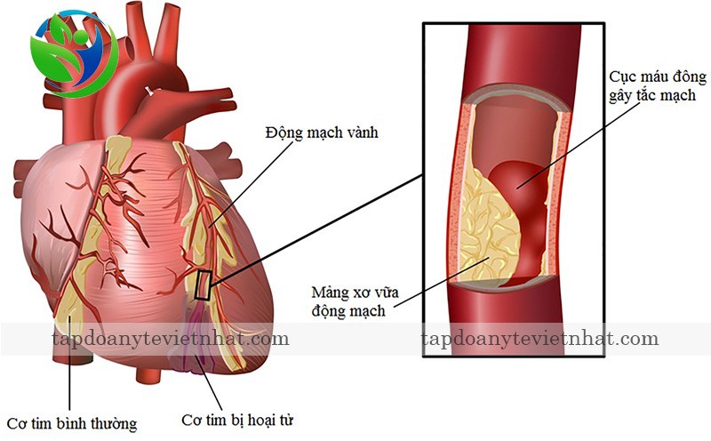 thiếu máu cơ tim là bệnh lý tim mạch phổ biến