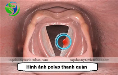 Bệnh Polyp thanh quản có nguy hiểm không? Nguyên nhân và cách điều trị