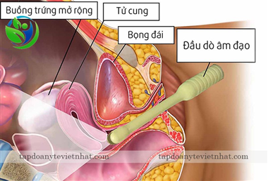 Siêu âm phụ khoa phát hiện được nhiều bệnh phụ lý nghiêm trọng