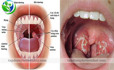 Viêm amidan là bệnh gì? Viêm amidan có tự khỏi không?