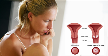 Tìm hiểu về viêm lộ tuyến cổ tử cung