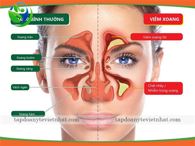 Bị viêm xoang cấp phải làm sao? Dấu hiệu nhận biết và cách điều trị