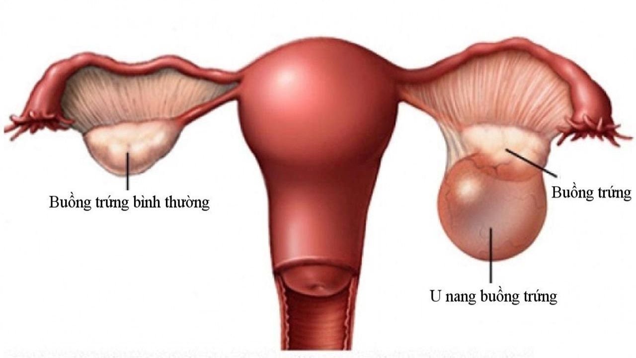 siêu âm có phát hiện u nang buồng trứng