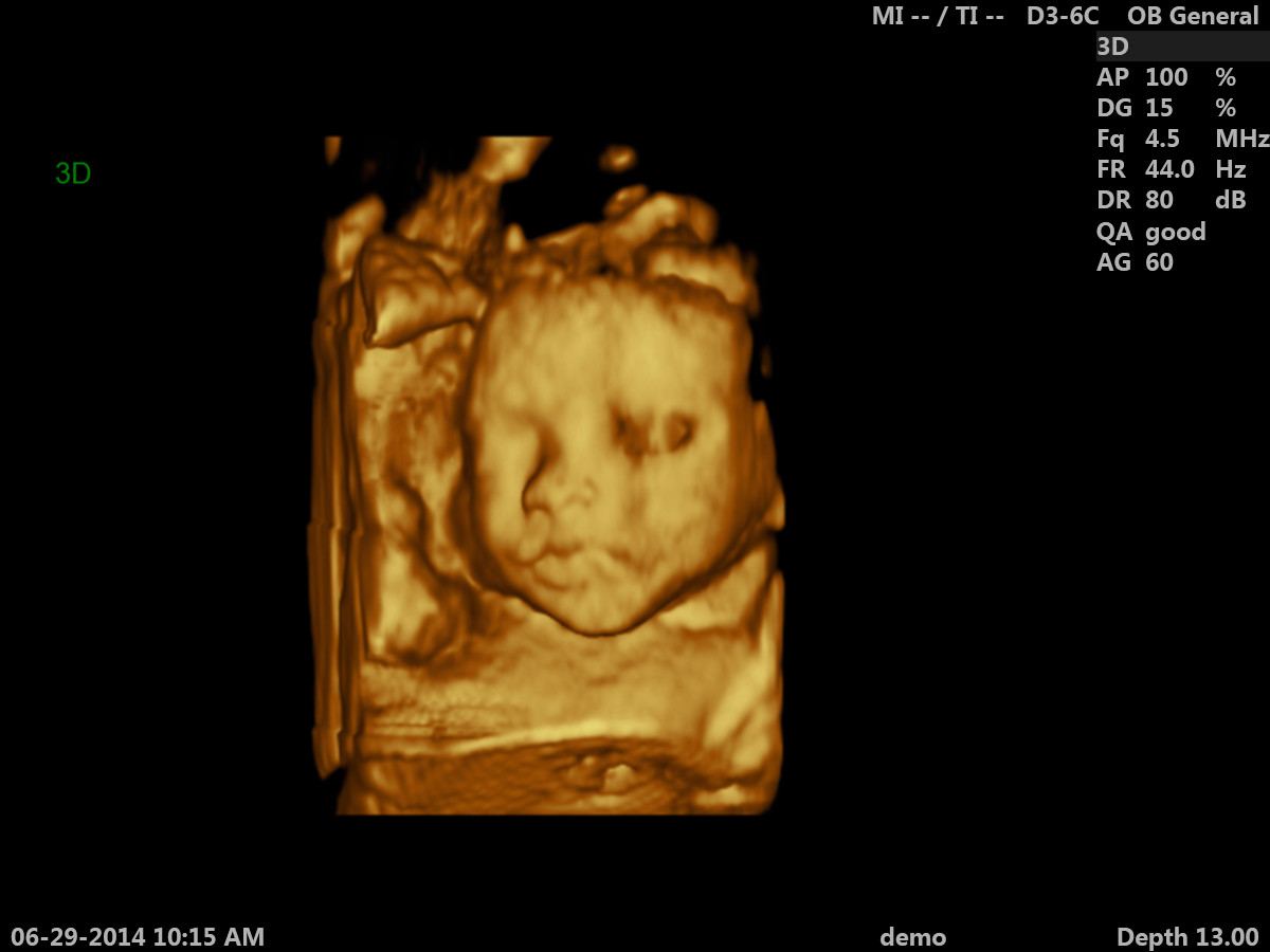 Siêu âm 4D trong thai kỳ 34 sẽ mang đến cho bạn một dự đoán về hình dáng và khí chất của bé yêu trong tương lai gần. Hãy để những khoảnh khắc đáng yêu khi bé chưa hẳn đã ra đời được ghi lại trong những bức ảnh siêu âm của chúng tôi.